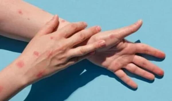মাঙ্কিপক্স: প্রথম মৃত্যু ভারতে, বাড়ছে আতঙ্ক