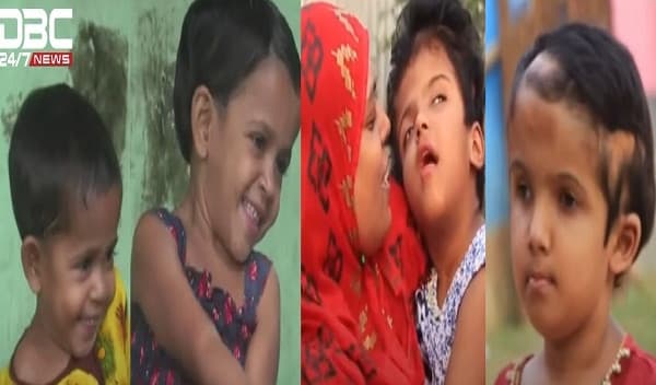 সুস্থ আছে জোড়ালাগা শিশু তোফা-তহুরা ও রাবেয়া-রোকাইয়া