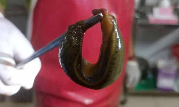 বরিশালে রোগীর মূত্রথলি থেকে জোঁক অপসারণ
