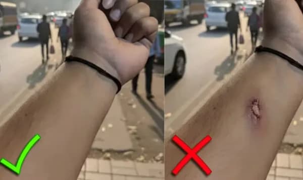 ভারতে এইচআরকে বোকা বানিয়ে এআই দিয়ে ‘নকল ক্ষত’ তৈরি করে যুবকের ছুটি আদায়!